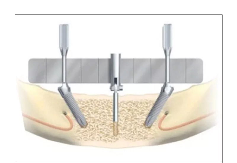 Dental Implant Surgical Guide Bendable Dental Implant Locating Guide Angle Rulers